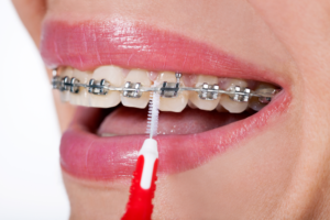5 Tips for Taking Care of Your Dental Braces While Traveling